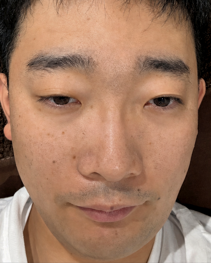 眉毛施術症例2 施術前